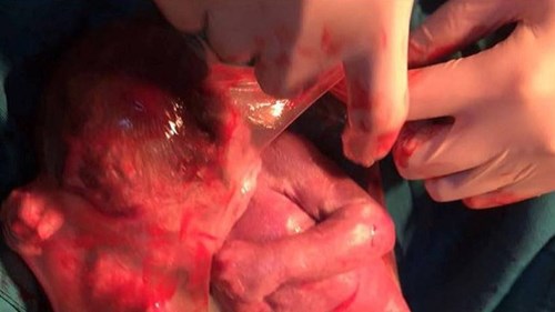 Nghệ An: Kinh ngạc bé gái chào đời còn nguyên túi ối