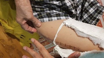 Hành trình đi tìm sự thật của ông bố có con gãy chân ở trường