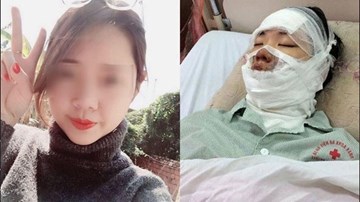 Cô gái trẻ bàng hoàng kể thời điểm nổ bóng bay bị bỏng cả khuôn mặt