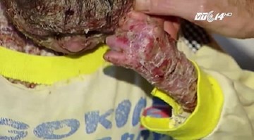 Chàng trai 16 tuổi chỉ nặng 9kg, da sần sùi như vỏ cây