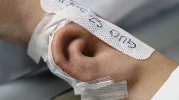 Kỳ lạ cảnh nuôi cấy tai trên cánh tay con người
