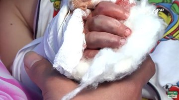 Phẫu thuật nối cổ tay bị đứt lìa cho bé trai bị kẹp thang cuốn