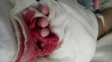 Đến viện thay băng, bé 5 tháng tuổi bị bác sỹ sơ ý cắt lìa ngón tay