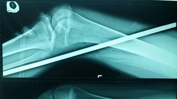 Đi qua công trình đang thi công, cô gái bị thanh sắt đâm xuyên chân