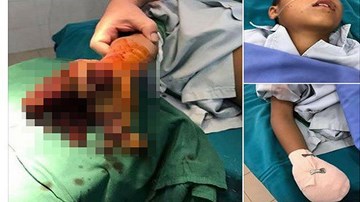 Dập nát tay do pin điện thoại phát nổ