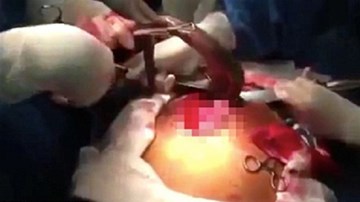 Bác sỹ mổ bụng, cứu người đàn ông nhét lươn qua hậu môn tìm cảm giác lạ