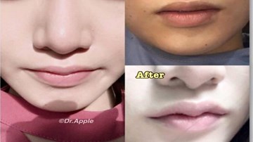 Thẩm mỹ 'môi sừng trâu' khiến giới trẻ 'ngậm đắng' không dám cười