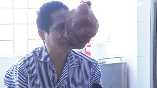 Người đàn ông mang khối u 4kg trên mặt cả chục năm