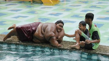 Cậu bé nặng nhất thế giới giảm 30 kg sau ca phẫu thuật dạ dày