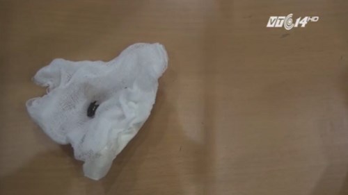 Nuốt nhầm bọ cánh cứng, mẹ xử lý sai khiến bé 8 tháng tuổi suýt mất mạng
