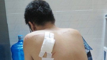 Nạn nhân kể lại giây phút bị chém, cướp xe máy ở Sài Gòn