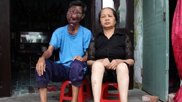 Người đàn ông mang gương mặt dị dạng đi ăn xin nuôi vợ tàn tật