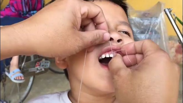 Are there any videos available that demonstrate how to extract a baby tooth at home?