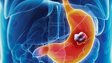 Ung thư dạ dày: 6 dấu hiệu cảnh báo sớm