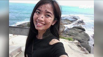 Cô gái có hàng trăm nốt ruồi thi Hoa hậu hoàn vũ