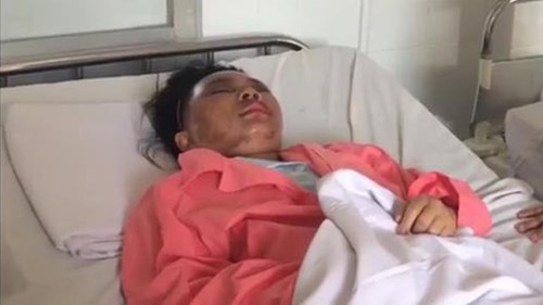 Cãi nhau với hàng xóm, cả nhà bị tạt axit: Cô gái 23 tuổi có nguy cơ bị mù