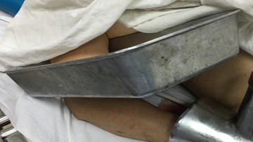 Người phụ nữ cấp cứu với bàn tay nằm trong máy xay thịt