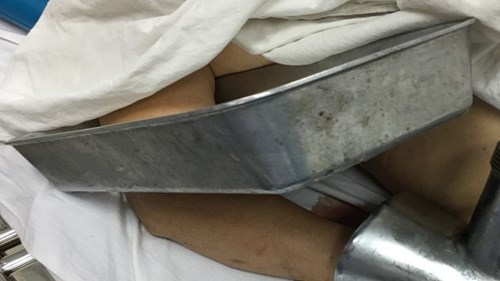 Người phụ nữ cấp cứu với bàn tay nằm trong máy xay thịt