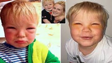 Bé trai 2 tuổi bị mù tạm thời vì mẹ nhuộm tóc