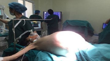 Cô gái trẻ mang khối u buồng trứng khổng lồ, nặng 16kg
