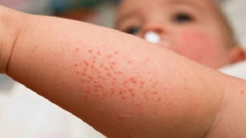 Sốt xuất huyết ở trẻ em: Triệu chứng, diễn biến, biến chứng ít ai biết