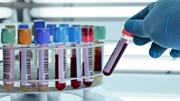 Xét nghiệm máu phát hiện được 13 loại ung thư khác nhau