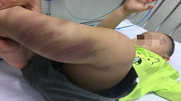 Bé 14 tháng nhập viện một mình trong nguy kịch, nghi bị bạo hành