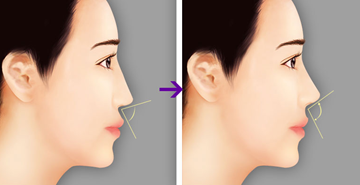 1 trường hợp thủng mũi do làm đẹp bằng chỉ