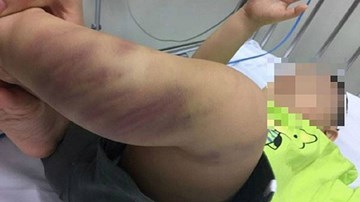 Khởi tố vụ án bạo hành bé trai 1 tuổi ở Hà Nội