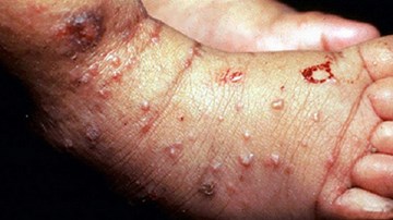 Mẹo chữa trị ghẻ lở với phương thuốc tự nhiên