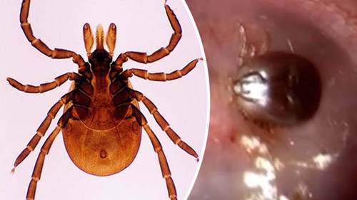 Sinh vật 8 chân hút máu bám chặt tai người không rời