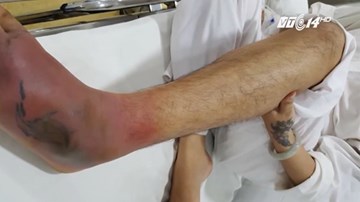 Nhiễm trùng huyết, chân mưng mủ vì xăm không an toàn