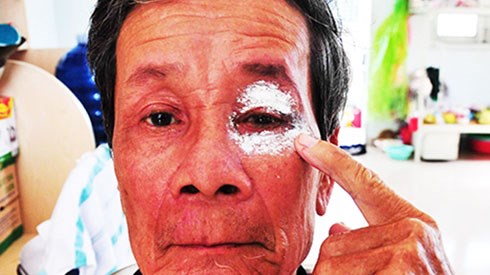 Người dân bị viêm loét da do nguồn nước