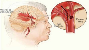 Những người có nguy cơ xuất huyết não