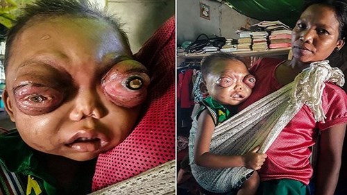 Bé 2 tuổi mắc bệnh lạ khiến mắt lồi như muốn nổ tung