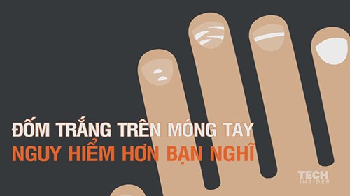 Nốt trắng trên móng tay nguy hiểm hơn bạn nghĩ