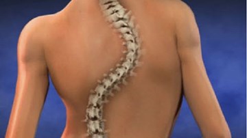 TP.HCM: Hội chứng lạ khiến cột sống thiếu nữ vẹo 69° như chữ S