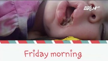 Bé 19 tháng tuổi suýt bị mất môi vì ngậm sạc điện thoại