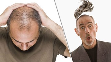 Tại sao chúng ta ai rồi cũng sẽ bị hói?