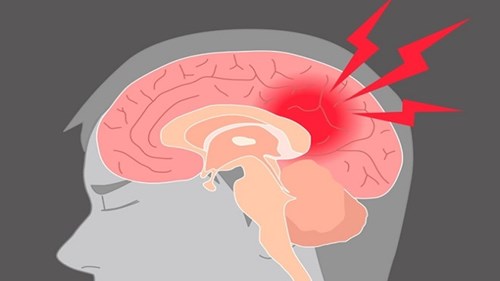 Điều gì xảy ra với não bộ khi bạn bị đập vào đầu?