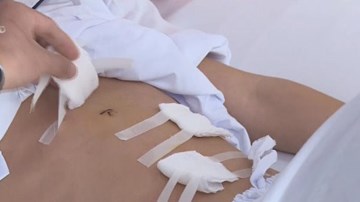 Cảnh báo người trẻ thủng dạ dày vì thói quen ăn uống