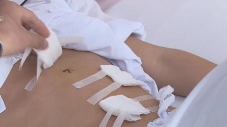 Cảnh báo người trẻ thủng dạ dày vì thói quen ăn uống
