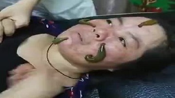Rợn người cảnh cho đỉa sống bò lên mặt để... trị mụn