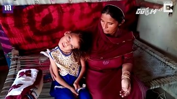 Pakistan: Bệnh lạ khiến bé gái bị gập nghiêng hẳn cổ