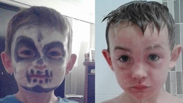 Cậu bé bị bỏng da mặt sau khi trang điểm chơi Halloween