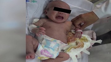 Phẫu thuật cho bé sơ sinh mang khối bướu lớn gần bằng cơ thể