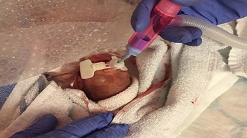 Cuộc chiến giành sự sống của bé trai sinh non chỉ nặng hơn 4 lạng