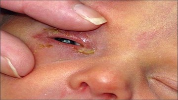 Trẻ sơ sinh thủng giác mạc vì mẹ chữa bệnh bằng cách nhỏ sữa vào mắt