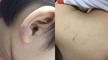 Cô giáo mầm non đánh con riêng của chồng phải nhập viện