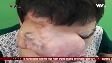 Cắt bỏ khối u nặng hơn 1kg trên khuôn mặt bệnh nhân